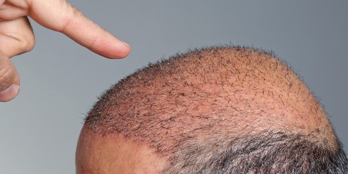 What Exactly Is A Hair Transplant?