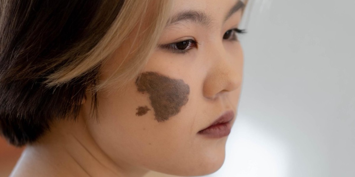 How Long Does Birthmark Removal Take? Riyadh Experts Explain