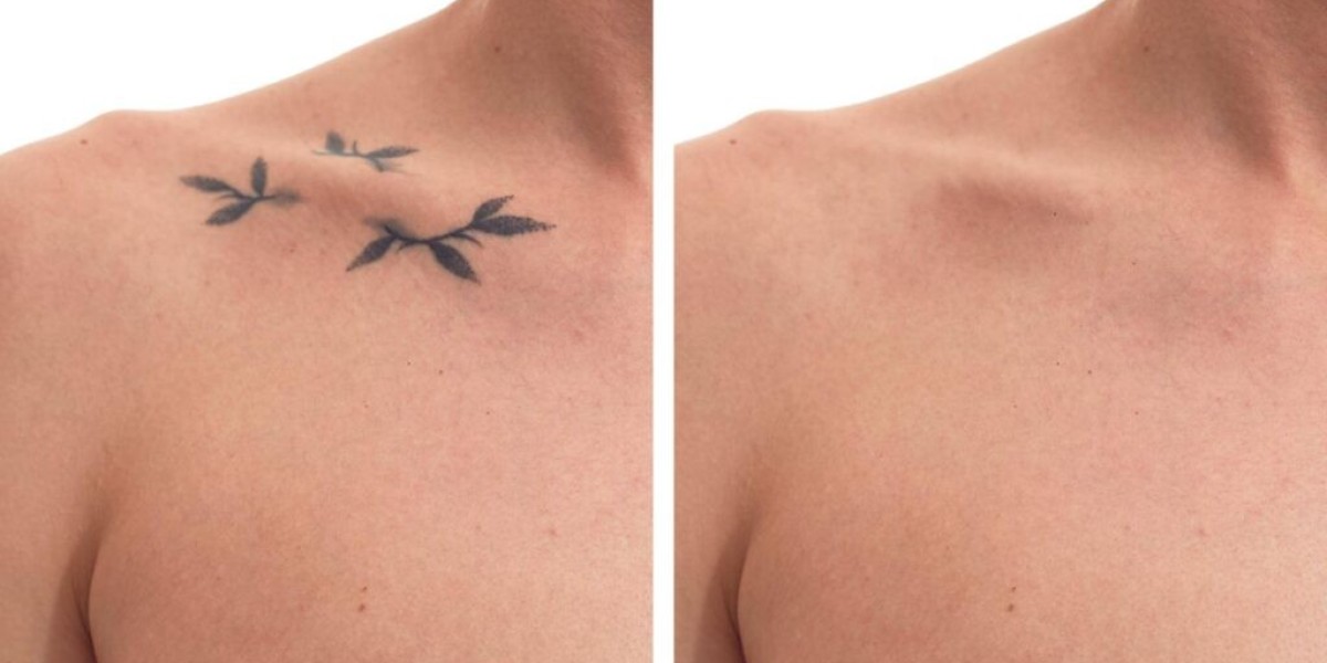 Laser Tattoo Removal: The Safe Way to Remove Unwanted Ink!