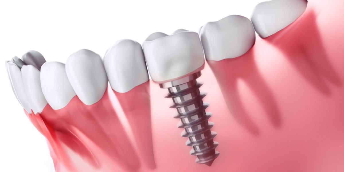 Why Dental Implants Stand Out as the Ideal Tooth Replacement