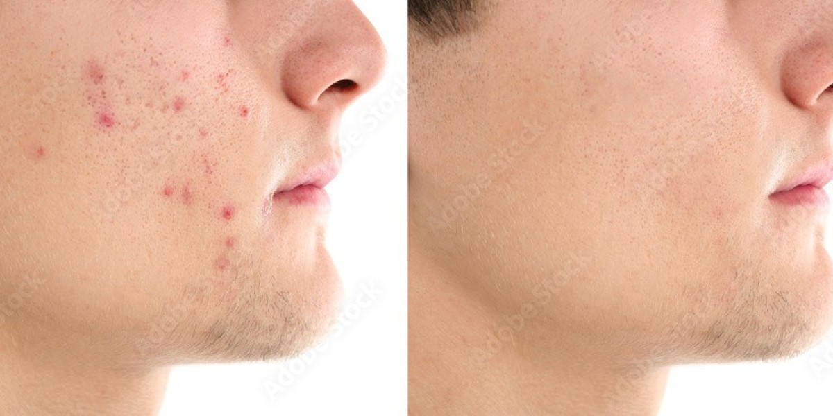 Acne Scar Removal in Riyadh: Safe and Proven Options