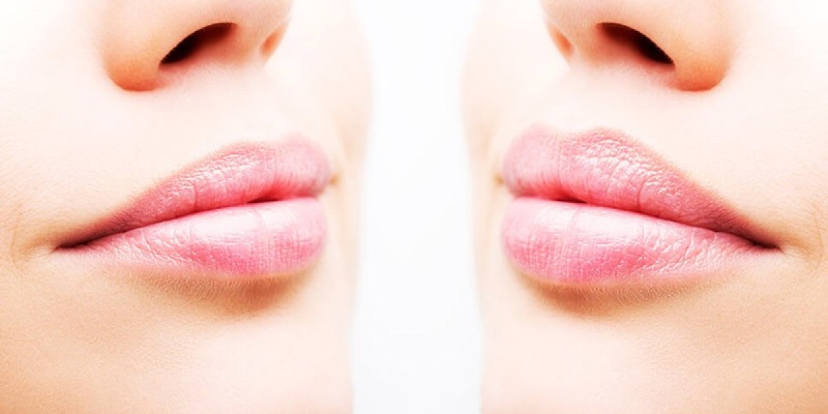 The Ultimate Guide to Getting Lip Filler Southampton: Everything You Need to Know