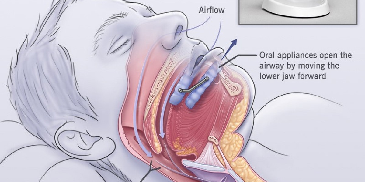 Sleep Apnea Oral Appliances Market: Innovations Driving Better Sleep Solutions
