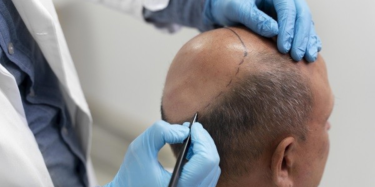 Hair Transplant for Men: How to Restore Your Hairline and Confidence