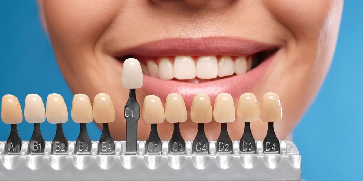 Expect from the Cost of Dental Veneers in Major Cities