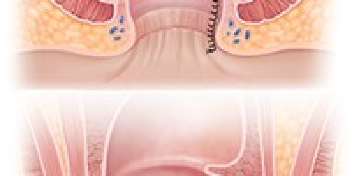 Your Journey to Comfort: Hemorrhoid Treatment in Riyadh