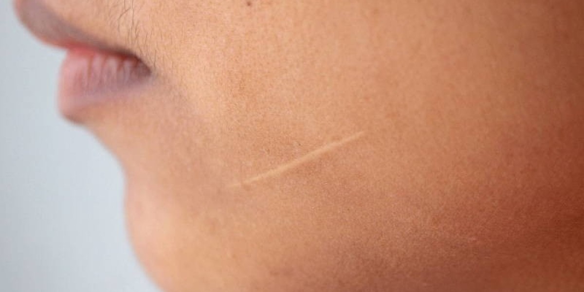 Why Riyadh Residents Are Choosing Laser Over Surgery for Scar Removal