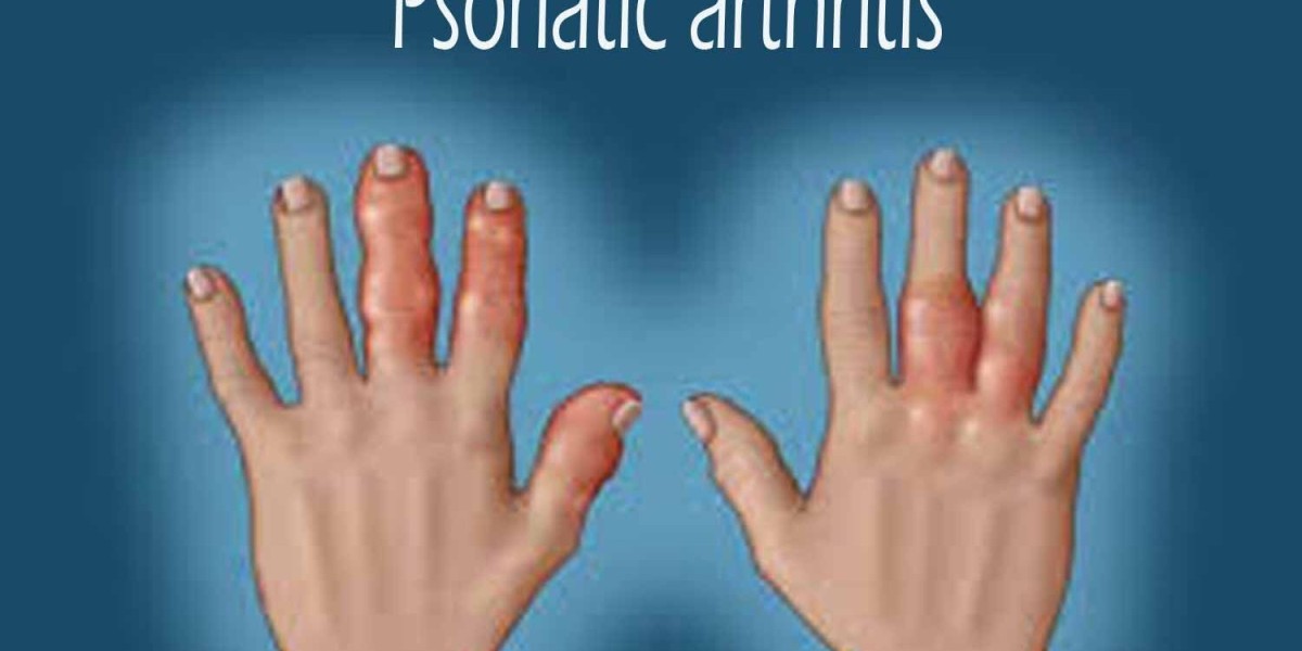 Arthritis Therapeutics Market : Understanding the Rising Demand for Effective Arthritis Treatments