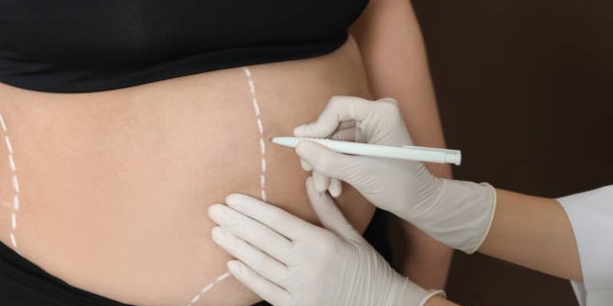 Laparoscopic Bariatric Surgery in Riyadh