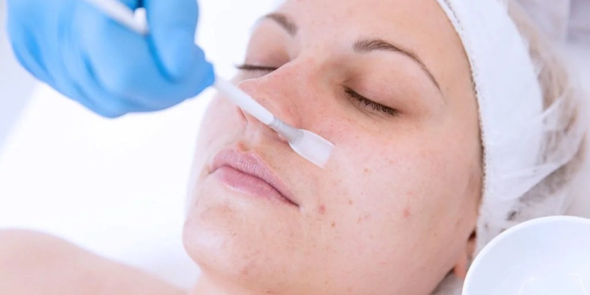 Which Is Better, Carbon Laser or Chemical Peeling for Youthful Skin