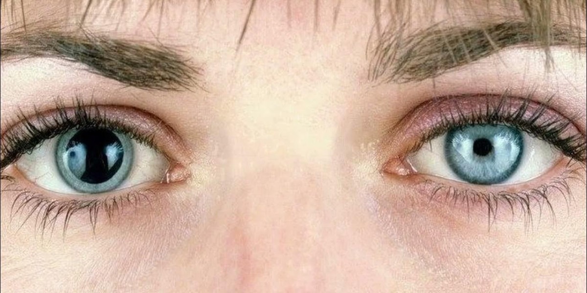 Small Pupils in Bright Light: Normal or Not?