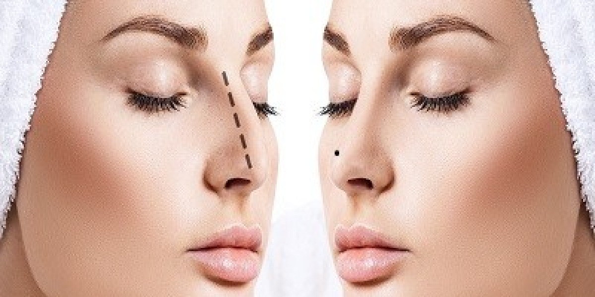 Advances in Rhinoplasty Techniques Used in Islamabad