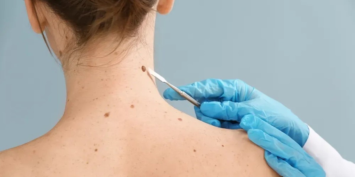 Understanding the Various Skin Tag Removal Services Offered