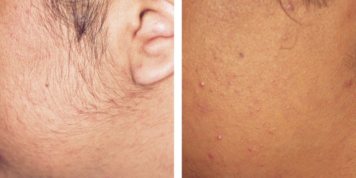 Experience Flawless Skin with Electrolysis in Dubai