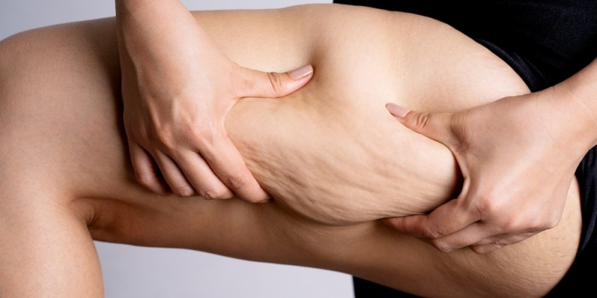 Cellulite Treatment That Celebrities Swear By