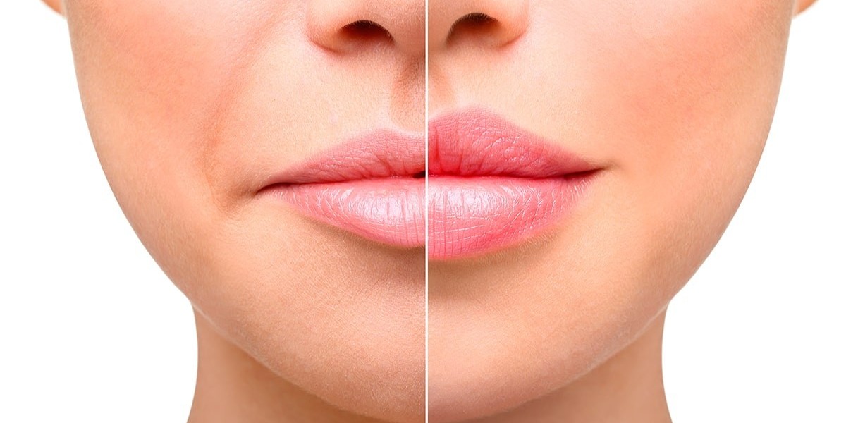 What to Expect During Lip Augmentation in Riyadh