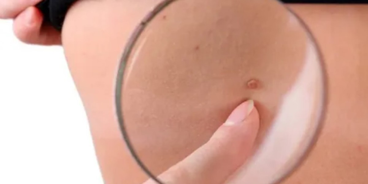 Laser vs. Surgical Birthmark Removal in Riyadh: Which Is Best?