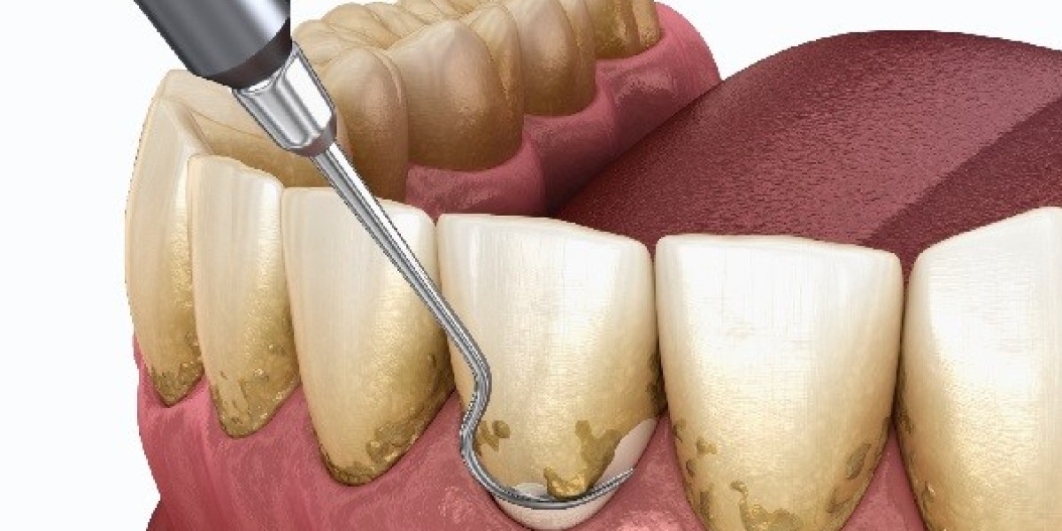 Periodontal Treatment Market Estimated to Experience a Hike in Growth by 2031