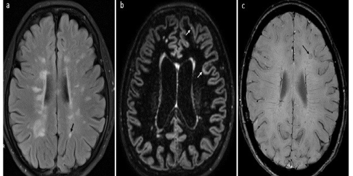 Primary Progressive Multiple Sclerosis Treatment Market Latest Trends with Future Insights by 2031