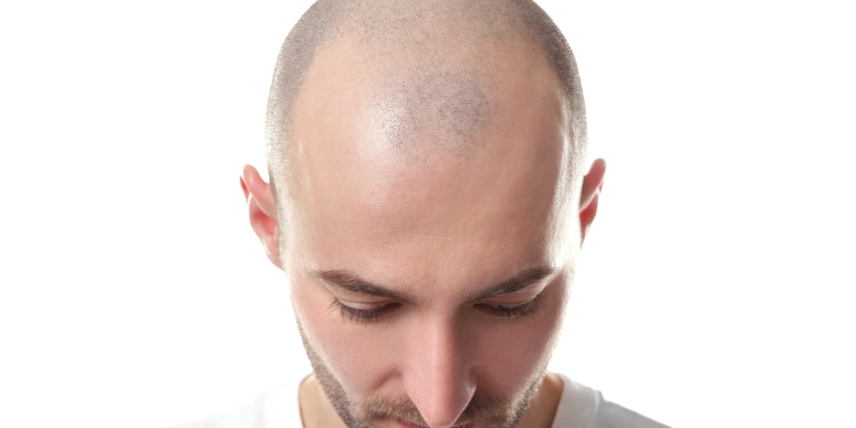 Hair Transplant Recovery Tips in Riyadh