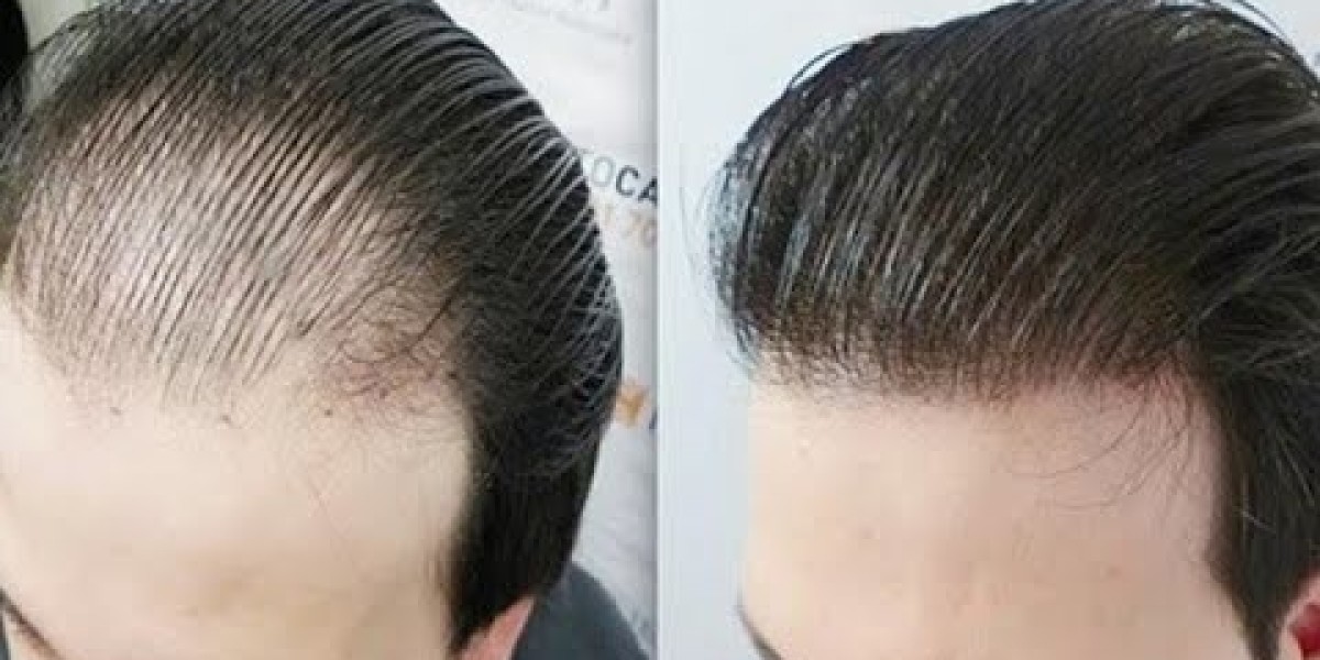 فضل تقنيات زراعة الشعر في دبي: كل ما تحتاج معرفته!