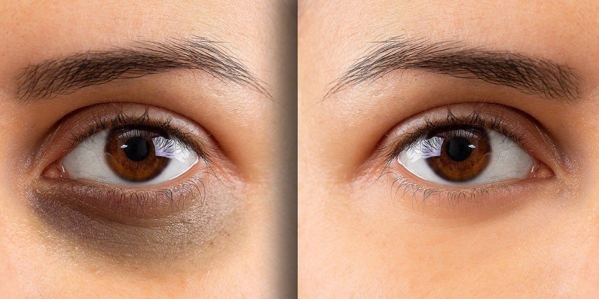 How Riyadh Clinics Are Tackling Genetic Dark Circles