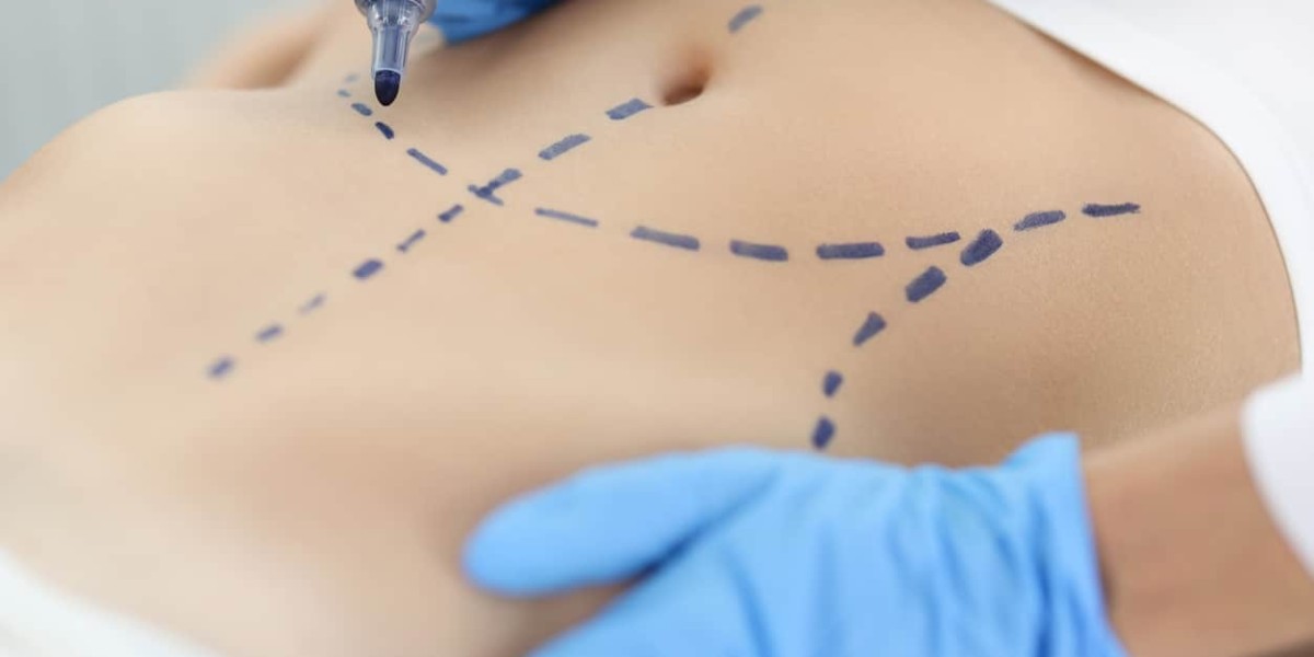Achieve the Shape You Desire with Liposuction That Works for You
