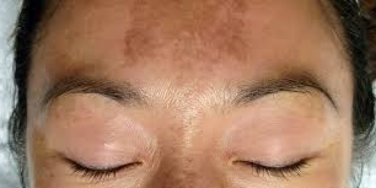 Surgical Options for Melasma: When to Consider Them