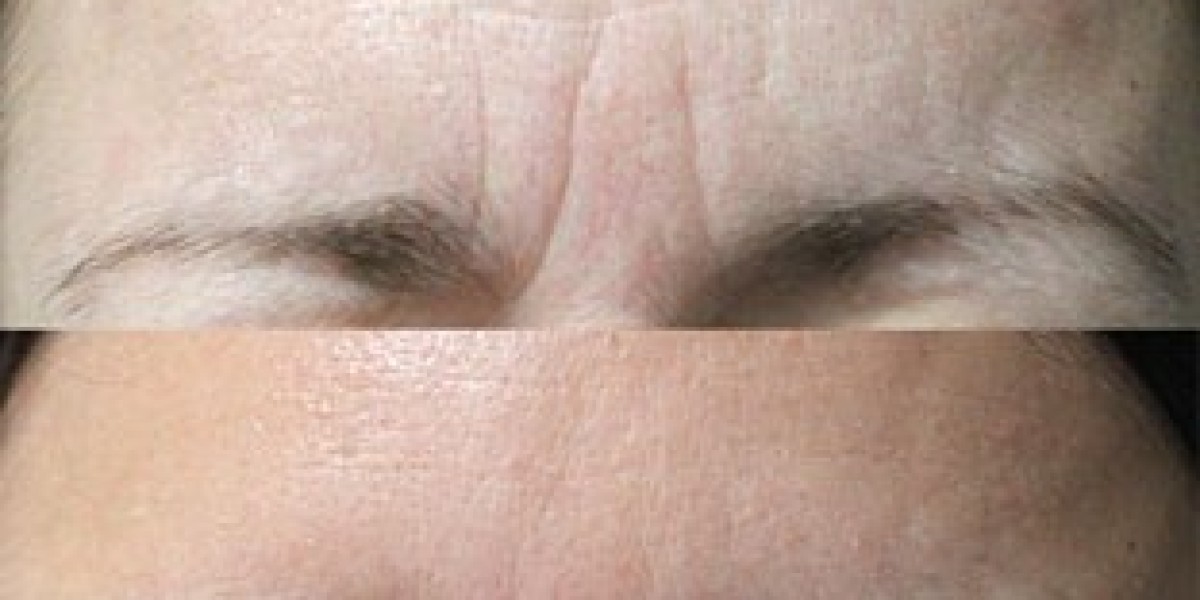 Smooth It Out: Everything You Need to Know About Botox Forehead Lines