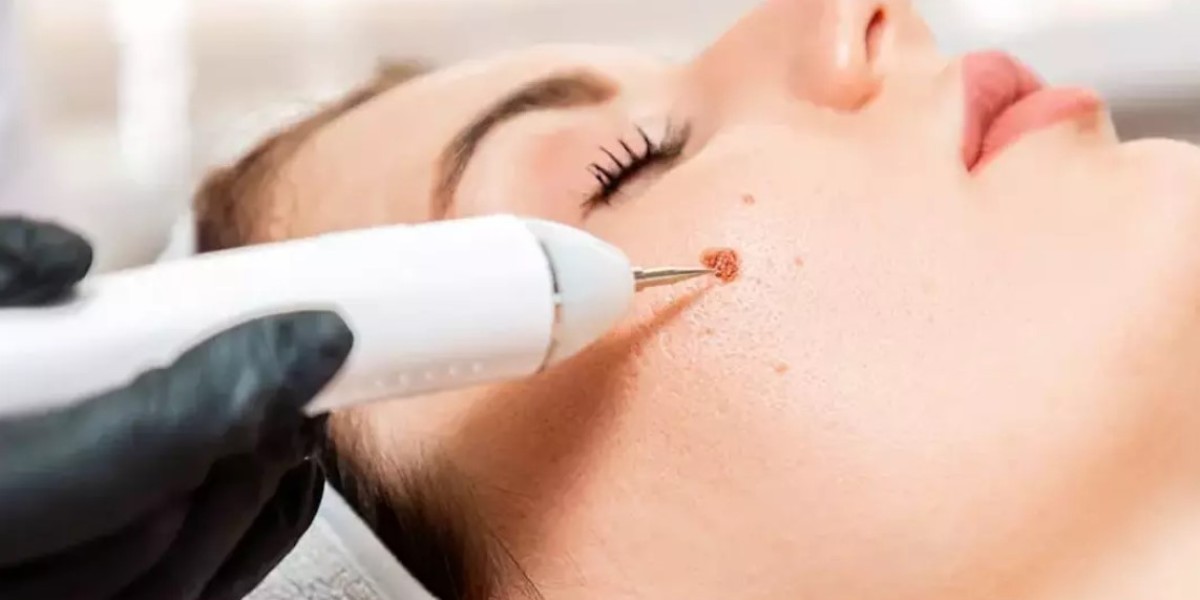 The Latest Mole Removal Technologies in Riyadh