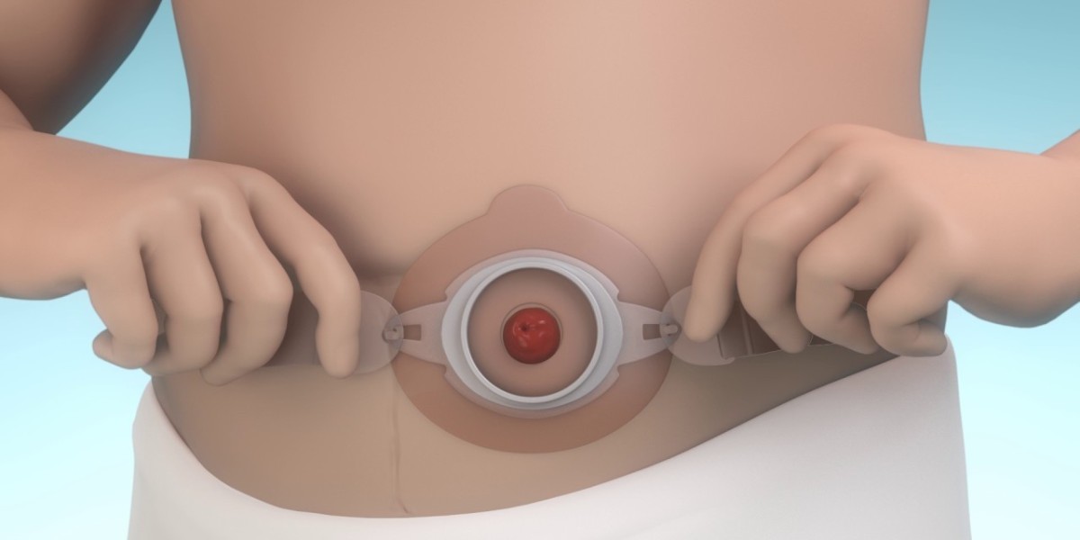 Ostomy Devices Market Witnesses Innovation Surge With Focus on Skin-Friendly and Leak-Proof Solutions
