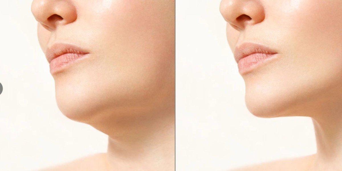 Chin Contouring & Fat Removal: Riyadh Clinics Ranked
