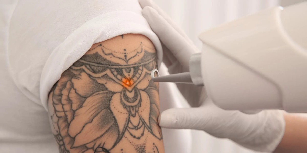 Get Your Glow Back: Laser Tattoo Removal That Transforms Confidence