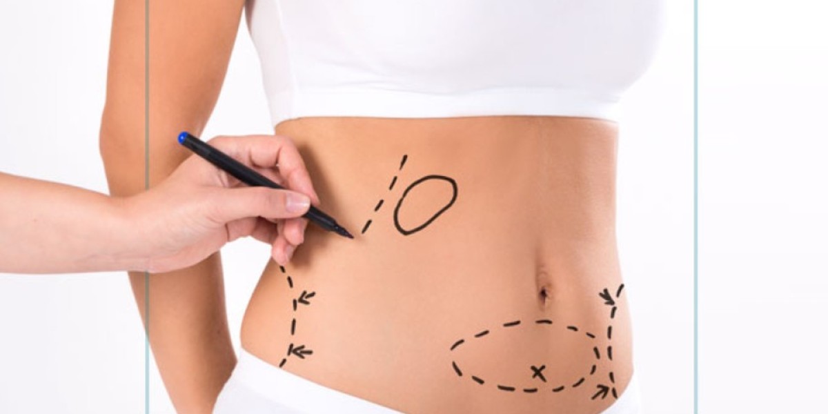 Can a Tummy Tuck Help with Diastasis Recti?