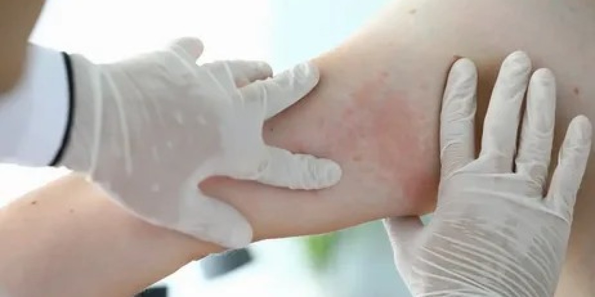 Atopic Dermatitis Market Projections Reveal Acceleration in Research Funding and FDA Approvals for Novel Drug Classes