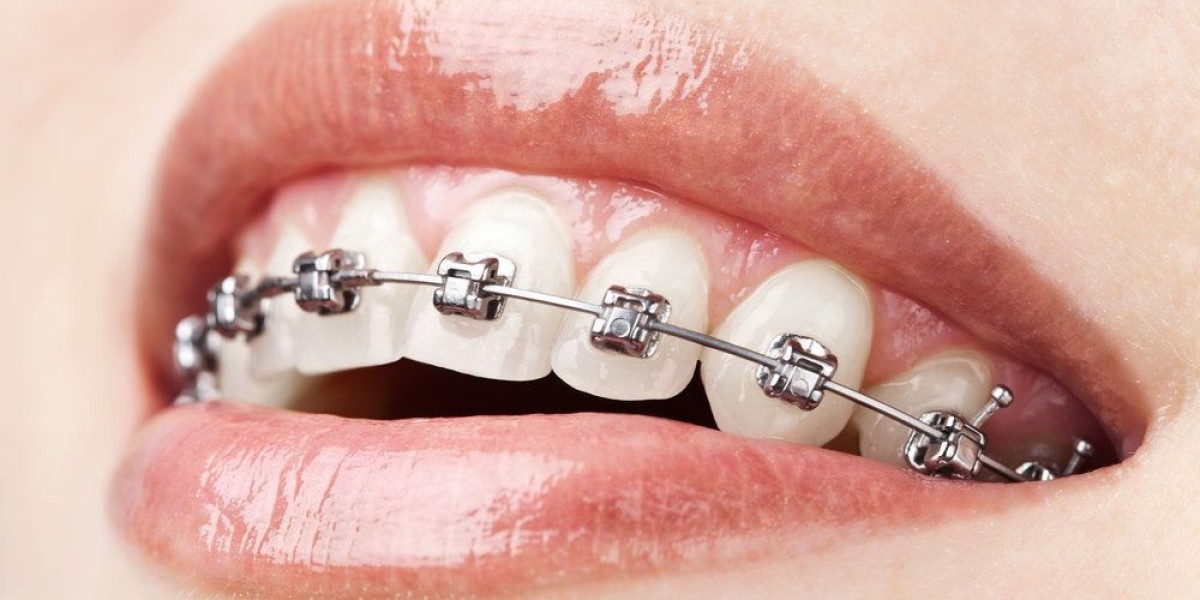 Dental Braces Cost Guide: Safe and Affordable Options That Work