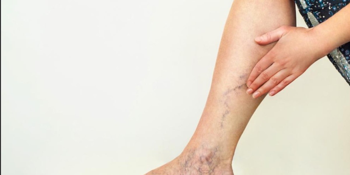 Safe and Affordable Vein Treatments in Riyadh