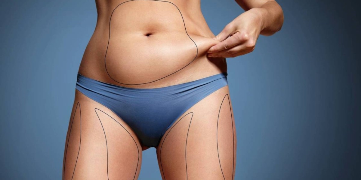 How Liposuction Helps You Achieve a Sculpted Body
