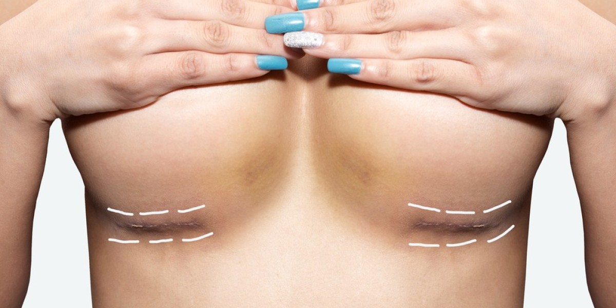 Life After Breast Reduction: What Changes Can You Expect?