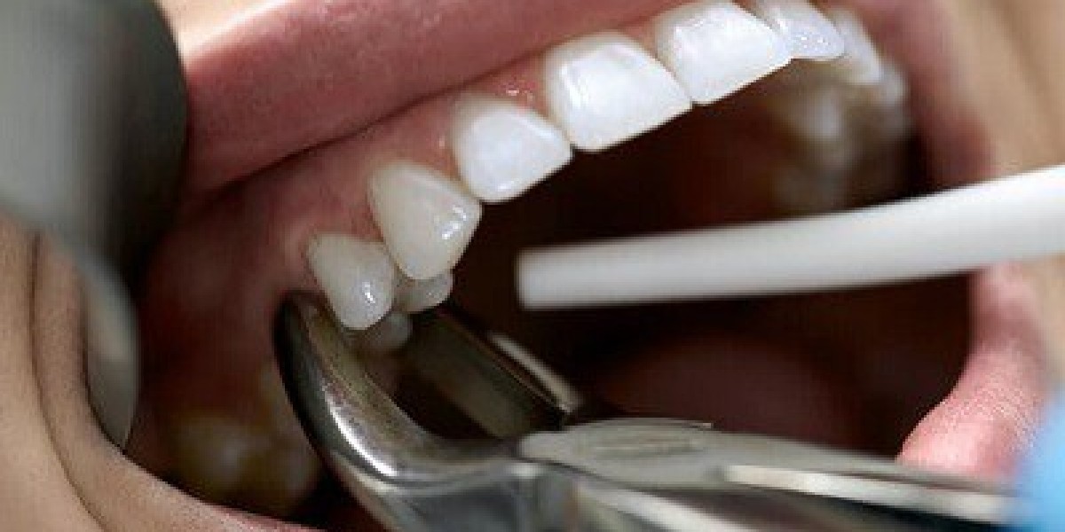 How Safe Is Tooth Extraction in Dubai?