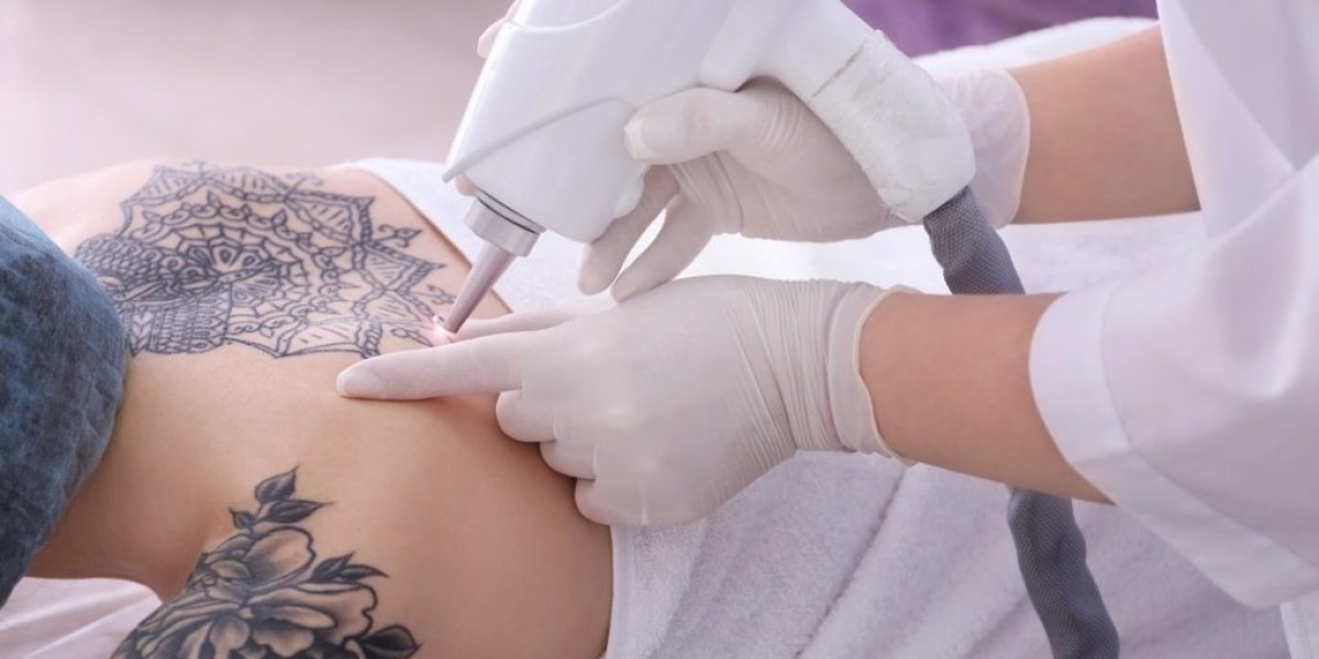 Laser Tattoo Removal: Your Path to Flawless, Tattoo-Free Skin!