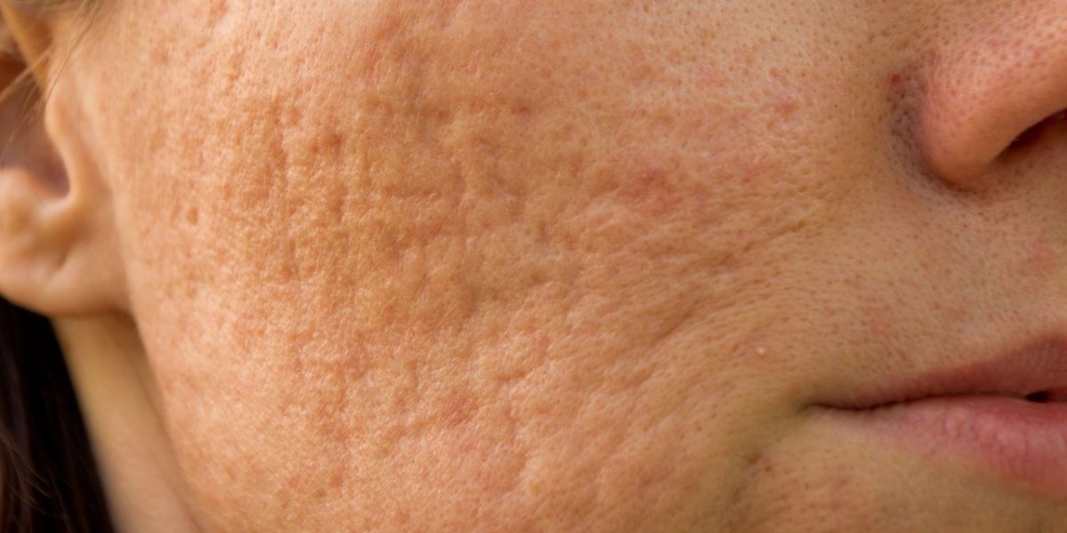 What to Know Before Getting Acne Scar Treatment in Riyadh