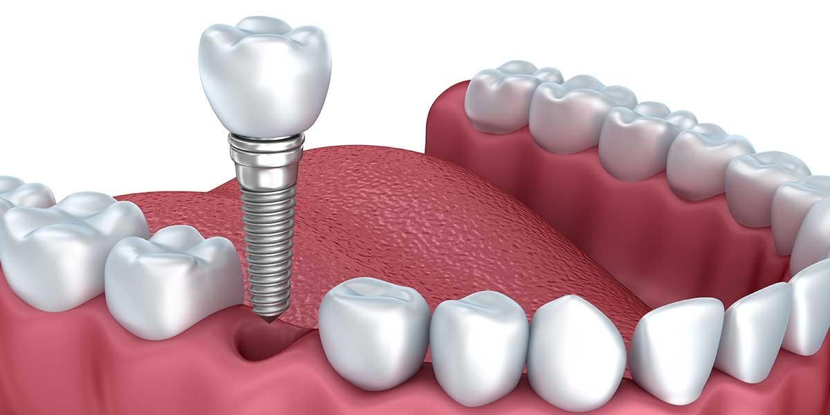 Fixed Dental Implants: A Permanent Fix for Missing Teeth