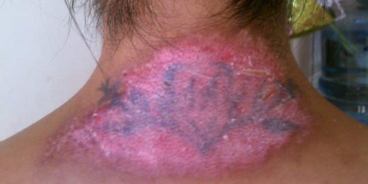 Why You Might See Signs of Injury After Laser Tattoo Removal