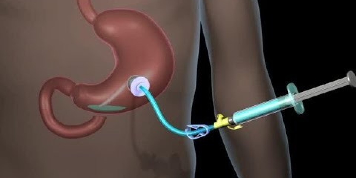 Feeding Tubes Market Dynamics: Analyzing the Demand for Feeding Tubes, Technological Trends, and Challenges