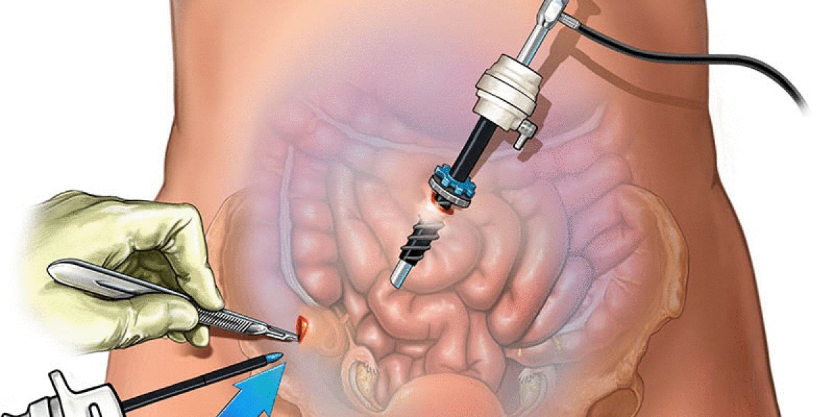 Minimally Invasive Surgery in Riyadh – Book Now