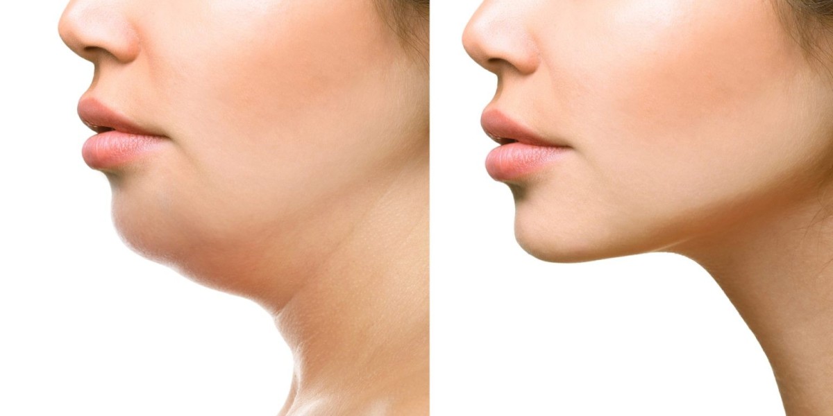 How Riyadh Clinics Are Tackling Double Chin with Technology