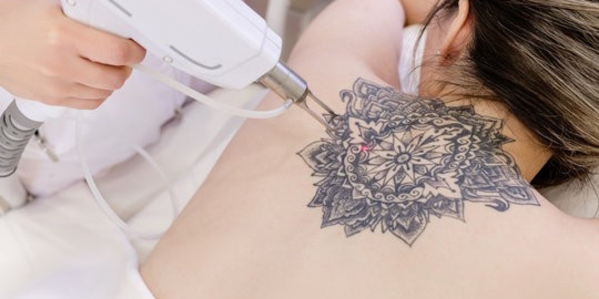 Skin You’ll Love Again: Laser Tattoo Removal in Dubai