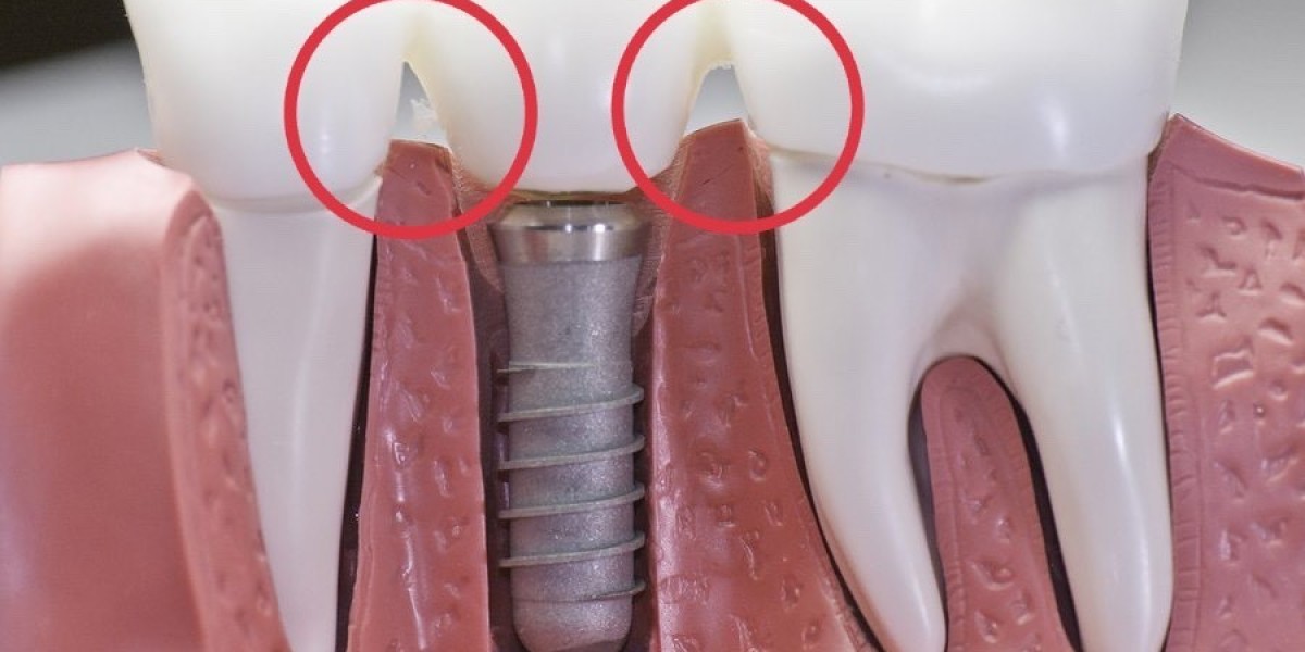 Có nên trồng răng implant không? Lời khuyên từ bác sĩ dành cho người mất răng