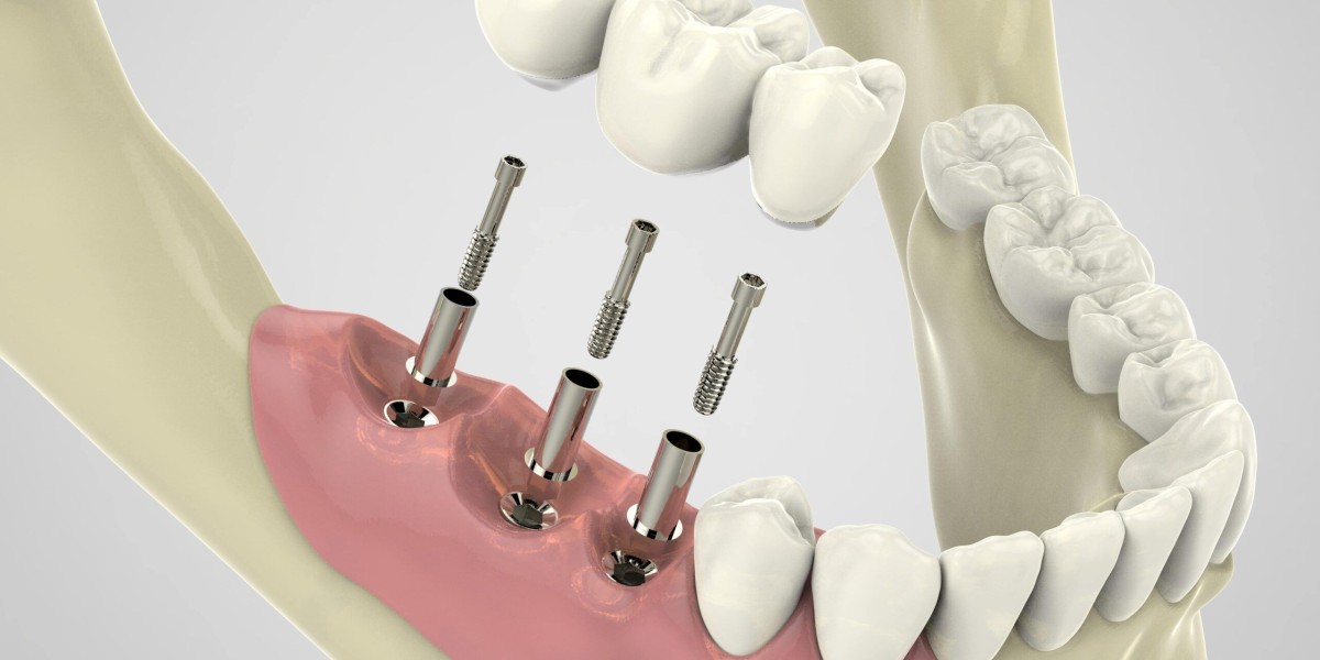 The Growing Demand for Dental Implants in Dubai Explained